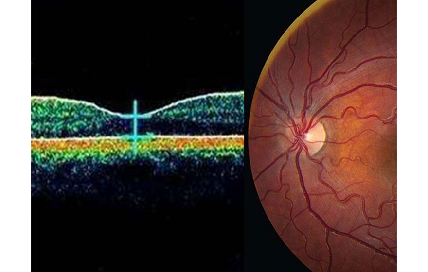 Aplicación del galvanómetro de barrido de Hans en imágenes oftalmológicas
